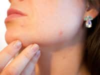 rimedi naturali per migliorare l'acne