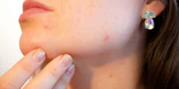 rimedi naturali per migliorare l'acne