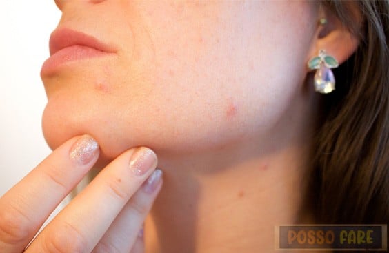 rimedi naturali per migliorare l'acne